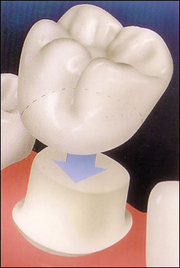 dental_crown_diagram