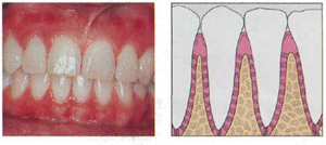 healthygums