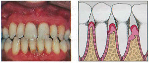 periodontitis