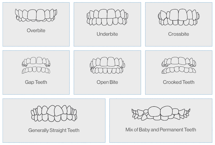 Steps to Straight Teeth - Choosing Invisalign® - Infinity Dental Associates